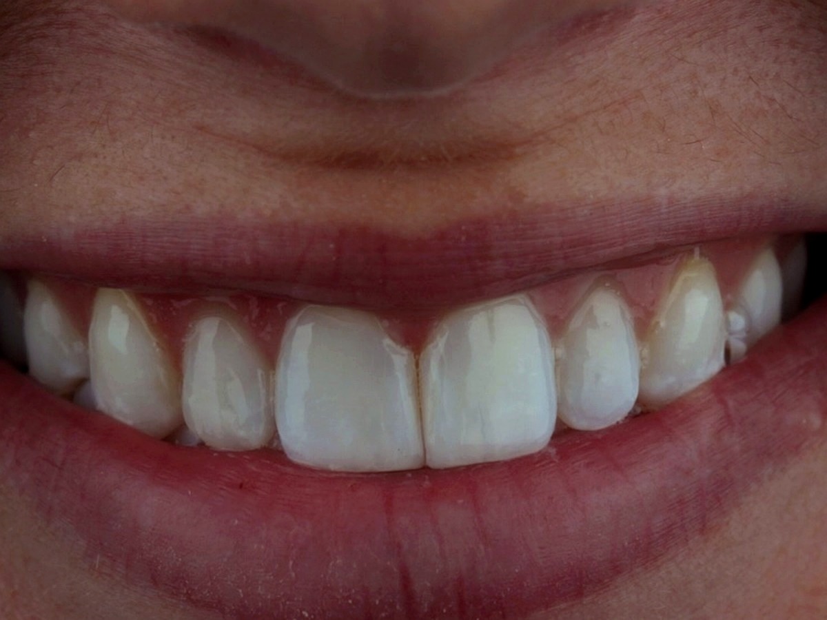 After — closed gap and refined shape