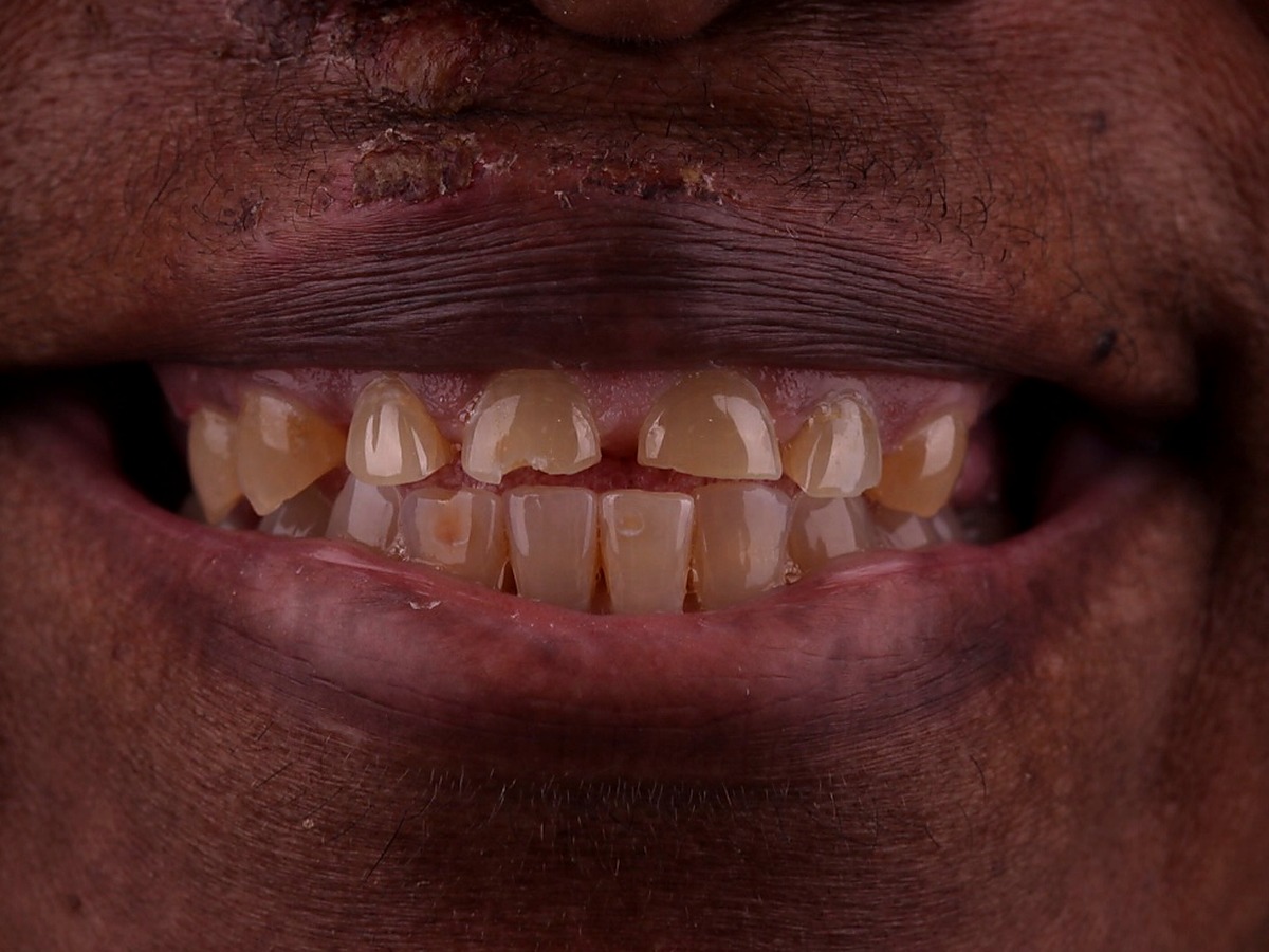 Before — chipped corner on the right central incisor after a facial trauma