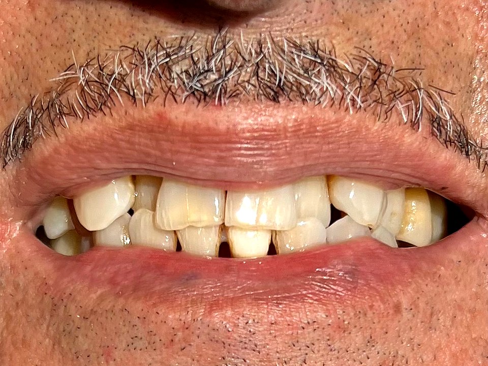 Antes — dentición deteriorada por enfermedad periodontal prolongada