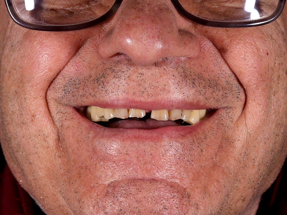 Antes — dentición fallida con dientes rotos y faltantes