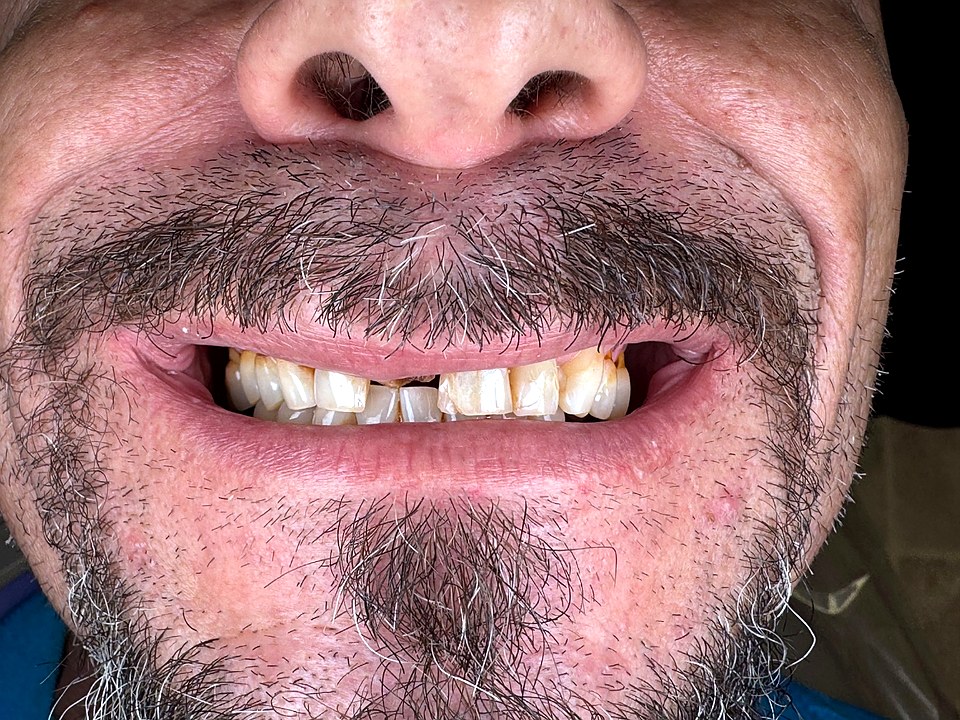 Antes — dientes anteriores desgastados y colapsados por falta de soporte posterior