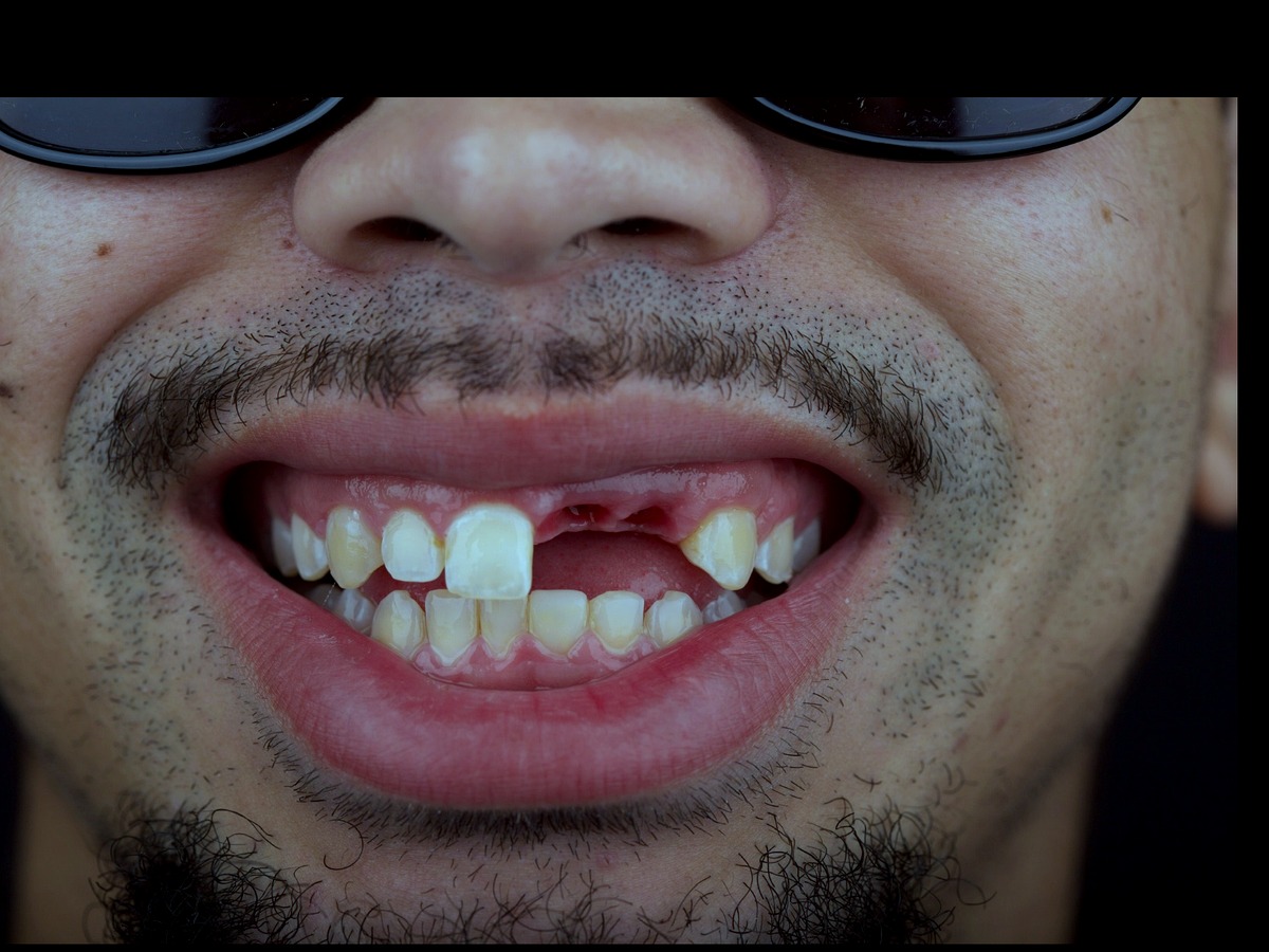 Before — two upper front teeth missing after trauma