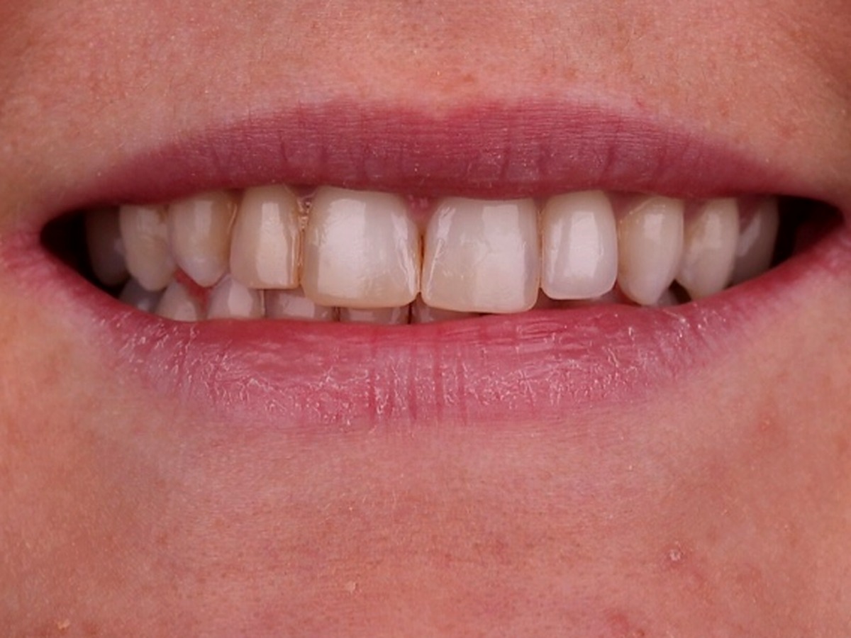 Before — uneven, yellowed old composite bondings on the upper front teeth
